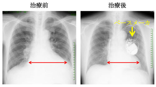 CRTによる治療前・治療後比較写真 CRTによる治療前・治療後比較写真