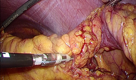 潰瘍性大腸炎に対する腹腔鏡下大腸全摘術