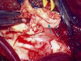 図8　頸動脈内膜剥離術（矢印が剥離された粥腫）