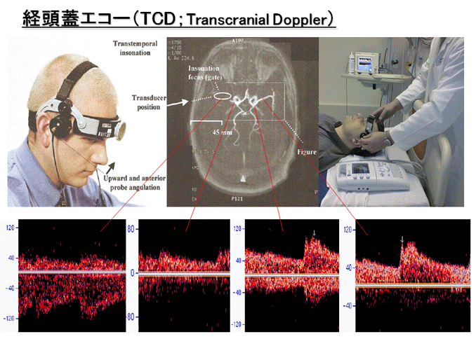 経頭蓋ドップラー超音波装置