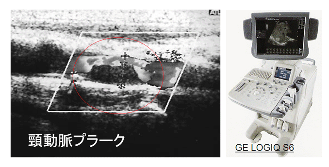 頸動脈専用の超音波装置