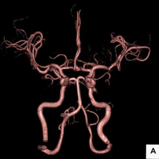 脳MR Angiography画像