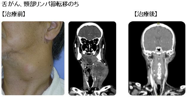 舌がん、頸部リンパ節転移のち