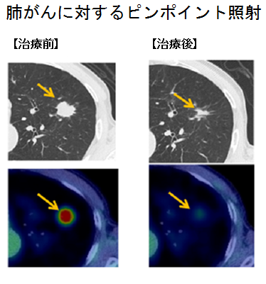 高精度放射線治療システムの御紹介