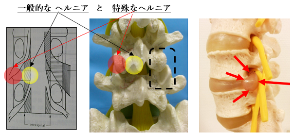 ヘルニア 膨隆 と 腰椎 椎間板