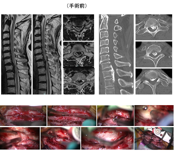 頚椎後縦靭帯骨化症 愛知医科大学病院