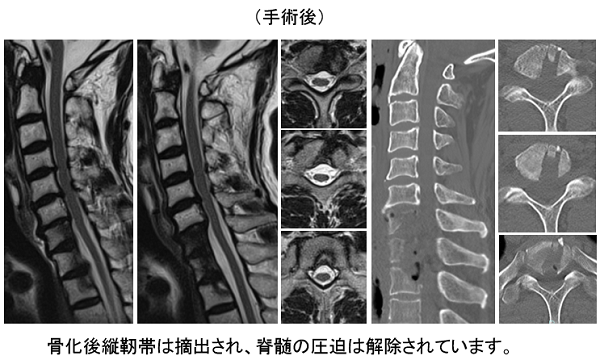 頚椎後縦靭帯骨化症 愛知医科大学病院