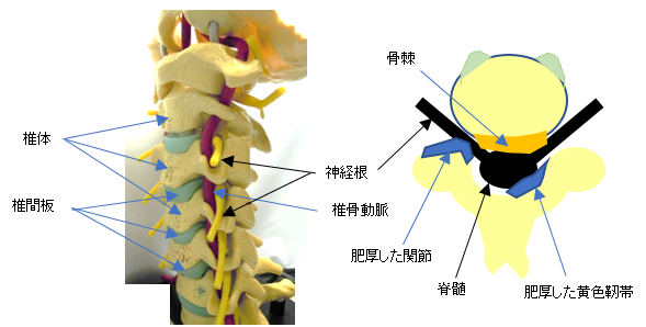 頚椎 症 性 神経 根 症 と は