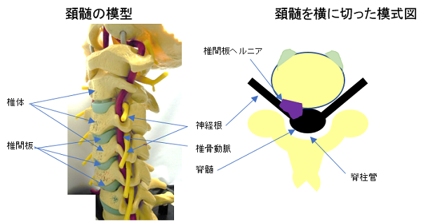 の ヘルニア 首