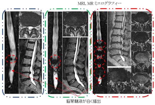 腰部脊柱管狭窄症 愛知医科大学病院