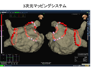 3次元マッピングシステム（CARTO）の画像