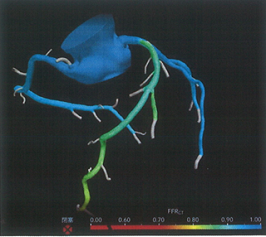 FFR-CT