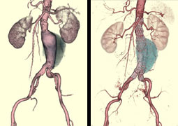 腹部大動脈瘤に対して，ステントグラフト内挿術施行