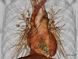 ＣＴ　Angiography