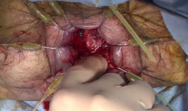 潰瘍性大腸炎に対する大腸全摘術の後に施行する回腸嚢肛門吻合