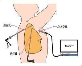 胸腔鏡下手術