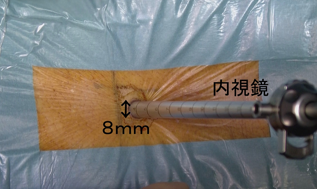 超低侵襲内視鏡下手術2