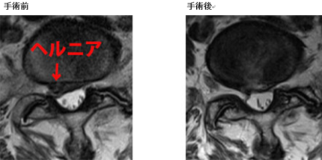 腰椎MRI