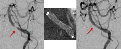 図11　めまいで発症した脳底動脈狭窄に対するステントを用いた血管拡張術