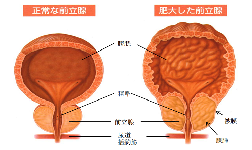 前立腺肥大症