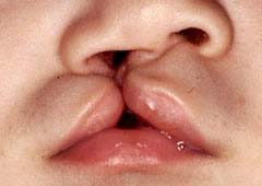 右側口唇裂の患児