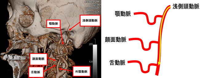 動脈の走行とカテーテル挿入の模式図