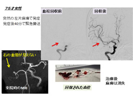 図２　脳塞栓に対する血栓回収療法