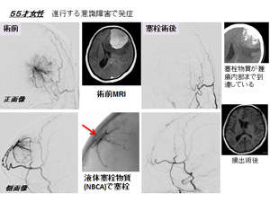 図６　脳腫瘍（髄膜腫）に対する塞栓術