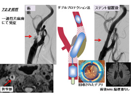 図３　頚動脈狭窄に対するステントを用いた血管拡張術