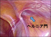 外鼠径ヘルニア