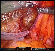 メッシュ留置・腹膜閉鎖