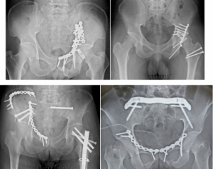 寛骨臼骨折手術症例（上），骨盤骨折手術症例（下）