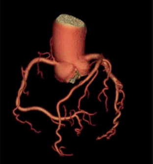 心臓の血管の３次元画像