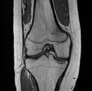 膝関節MRI画像