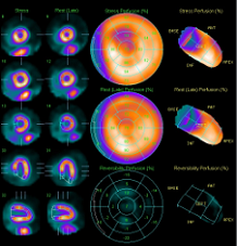 心筋シンチグラフィ