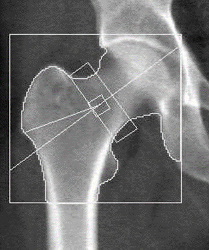 大腿骨骨量測定
