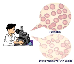 検査相談コーナー 血液 尿検査 貧血とはどういうことですか 愛知医科大学病院