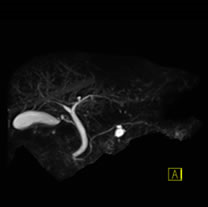 ステント mri