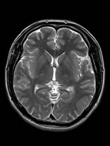 Mri ステント ステントを入れている人はＭＲＩは撮影できますか？