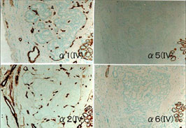 乳癌におけるα（IV）鎖の発現（Nakano S et al, Lab Invest 1999）